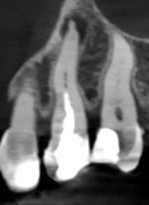 Zęby przed zabiegiem