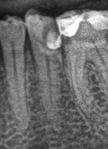 Zęby przed zabiegiem