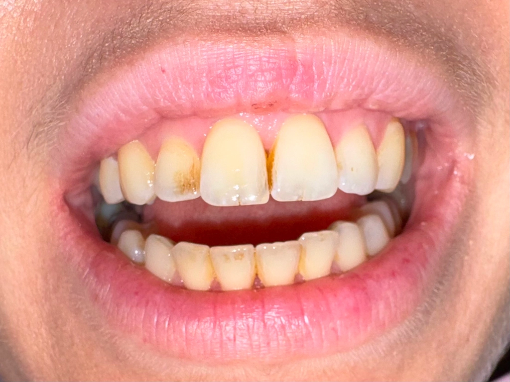 Zęby przed zabiegiem