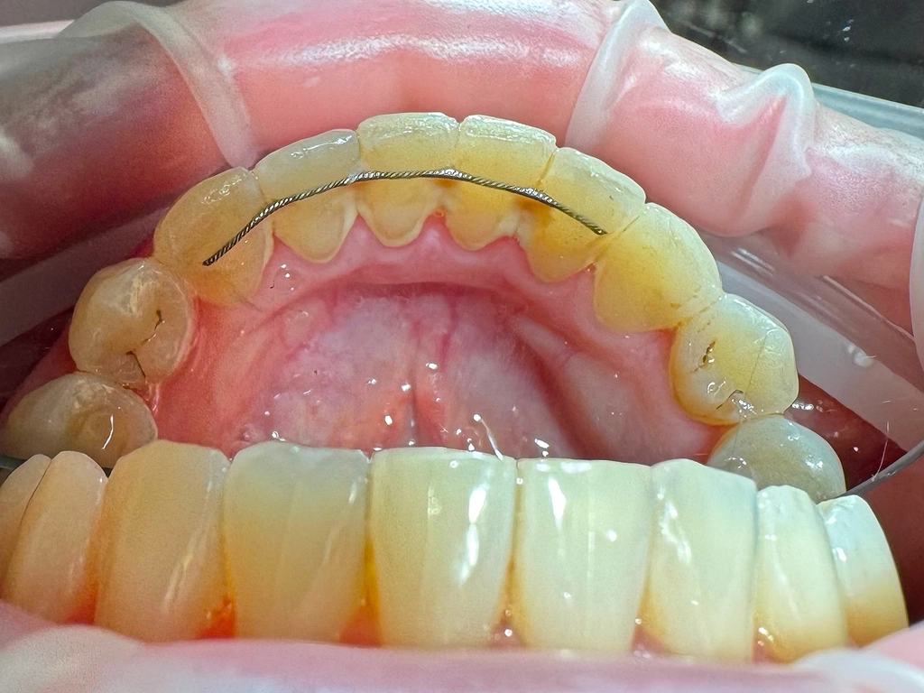 Zęby przed zabiegiem