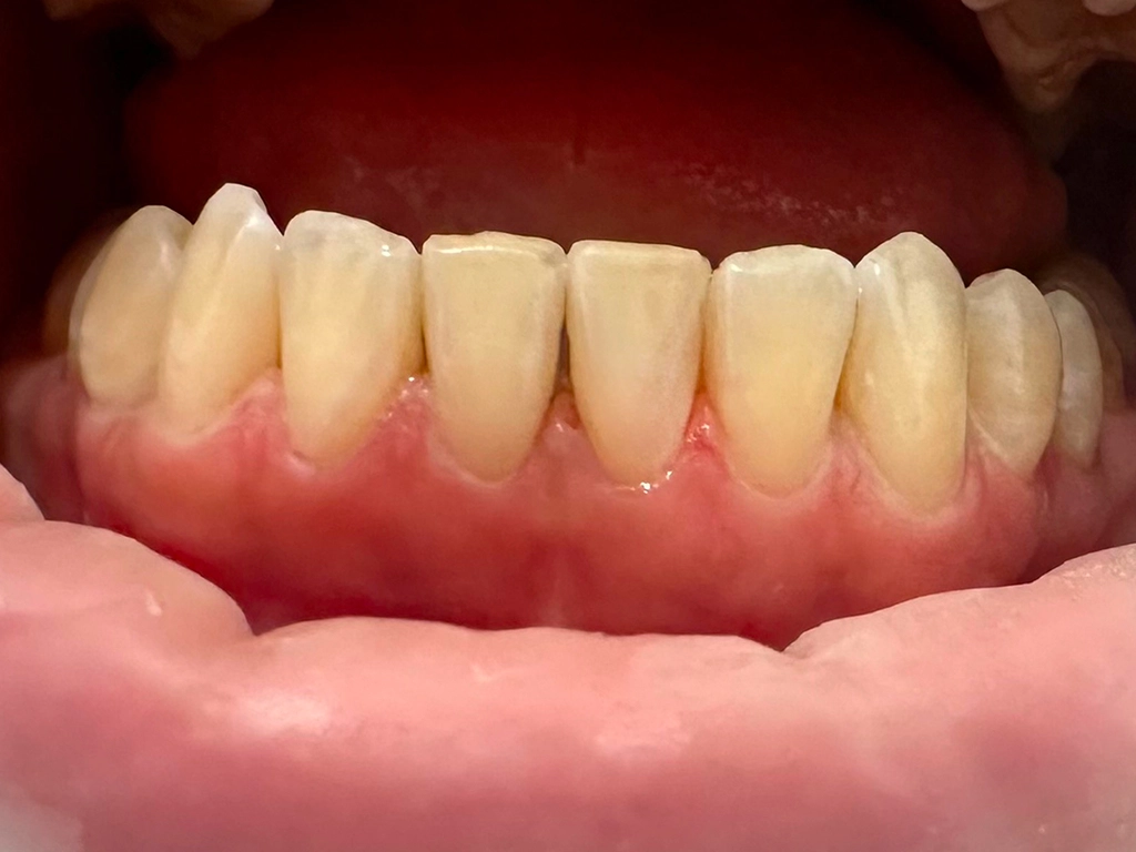 Zęby po zabiegu