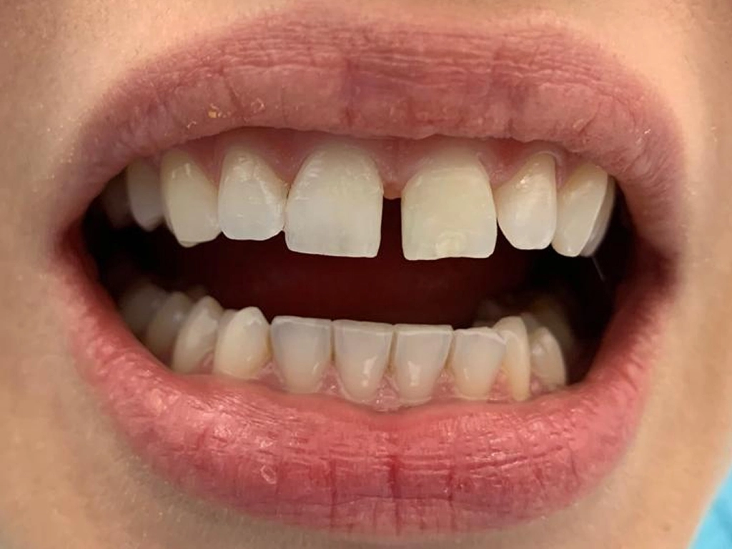 Zęby przed zabiegiem