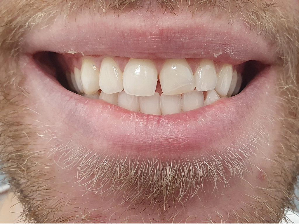 Zęby przed zabiegiem