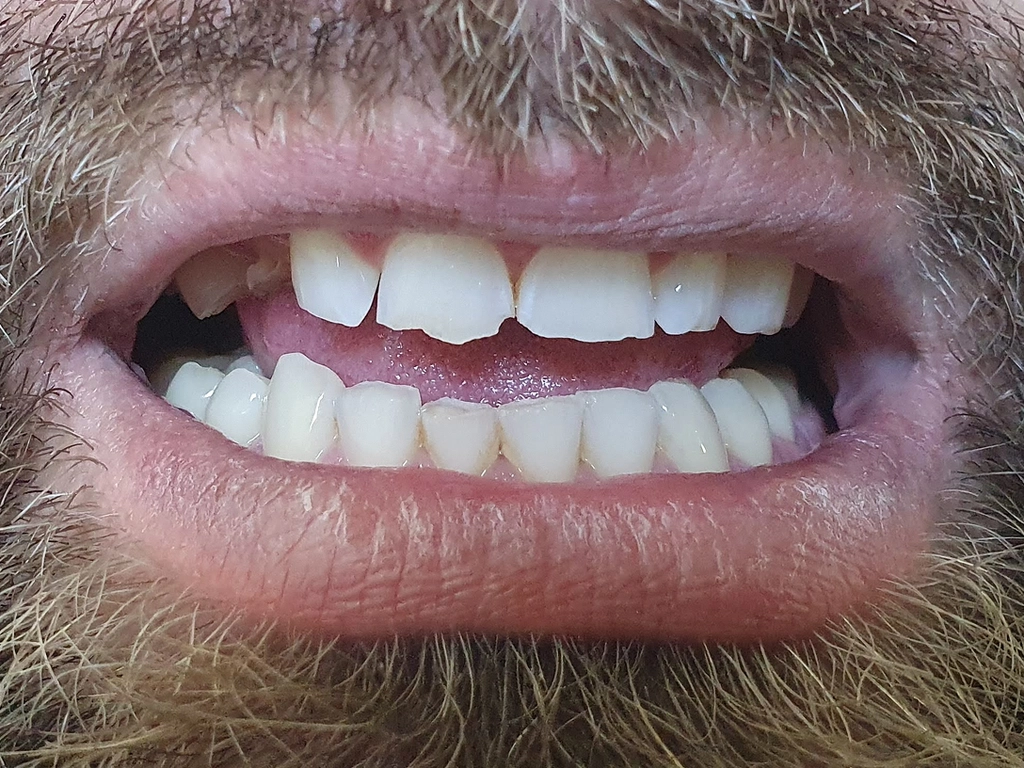 Zęby przed zabiegiem