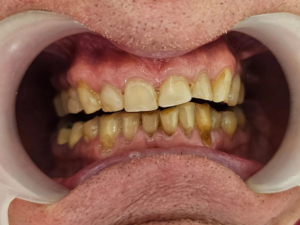 Zęby przed zabiegiem