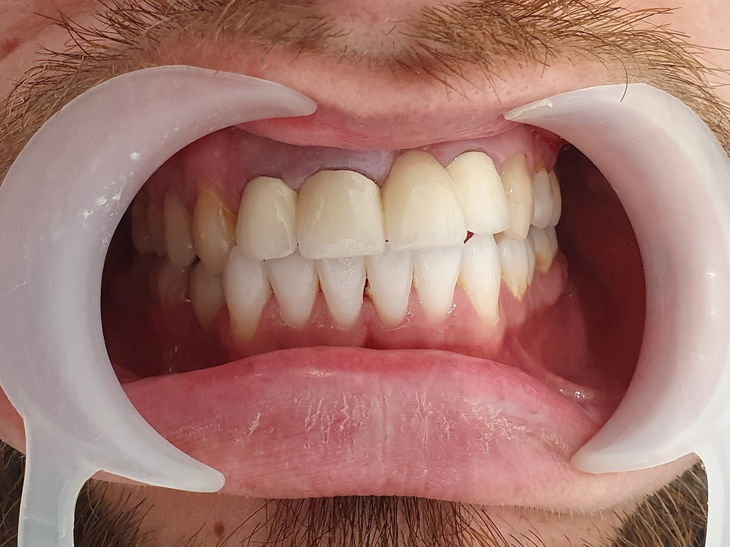 Zęby przed zabiegiem