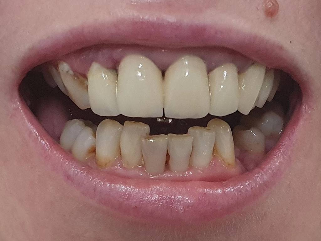 Zęby przed zabiegiem