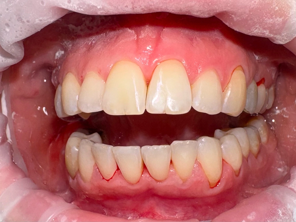 Zęby po zabiegu