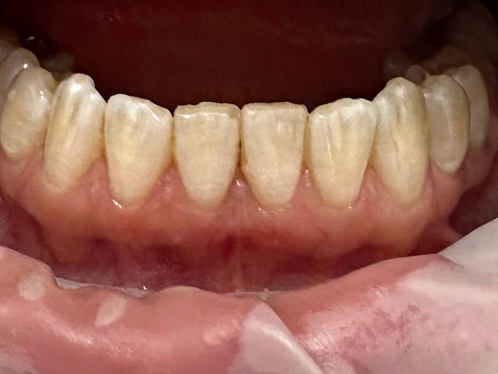 Zęby przed zabiegiem