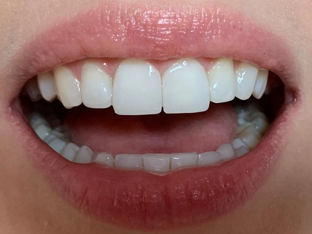 Zęby po zabiegu