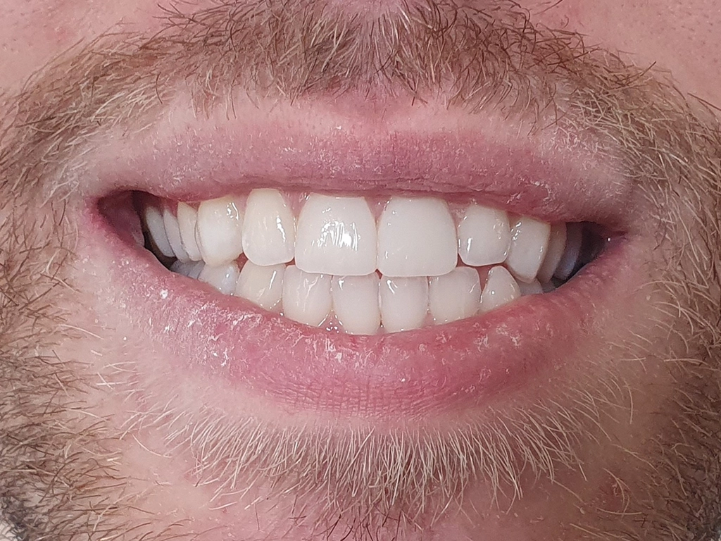 Zęby po zabiegu