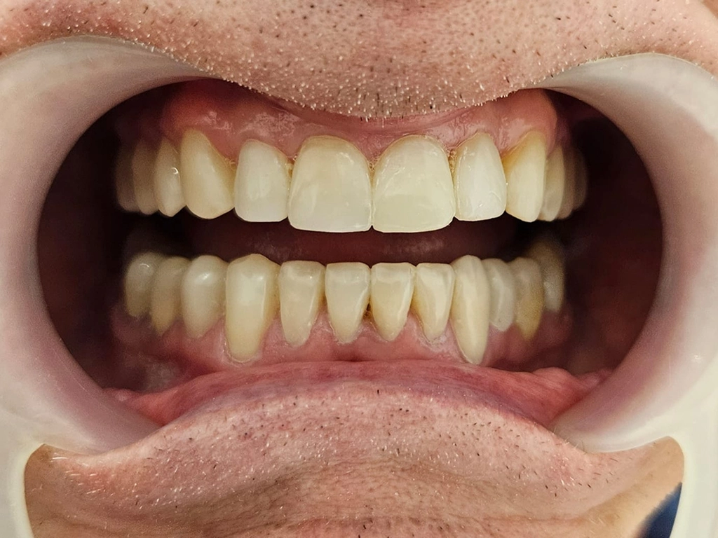 Zęby po zabiegu