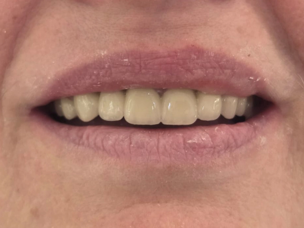 Zęby po zabiegu