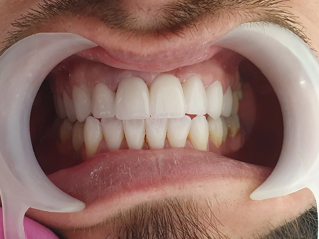 Zęby po zabiegu